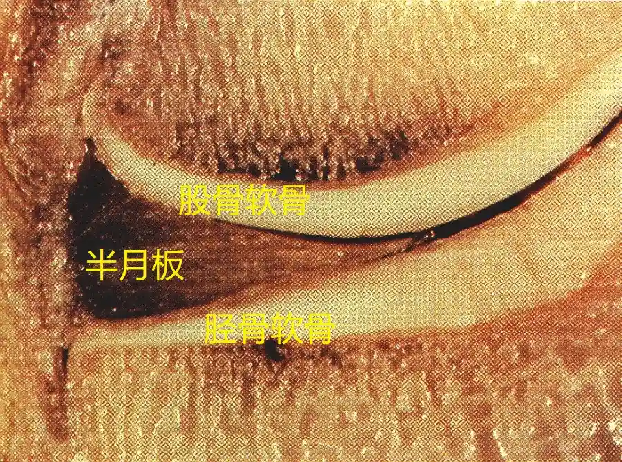 每一个半月板在撕裂时都应该尽全力去修补