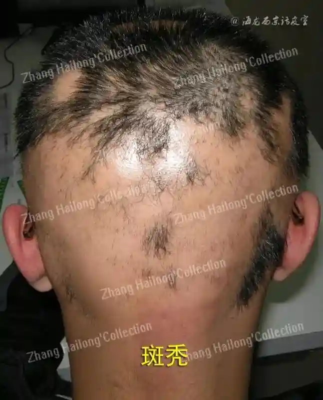 "斑秃"都有哪些治疗？