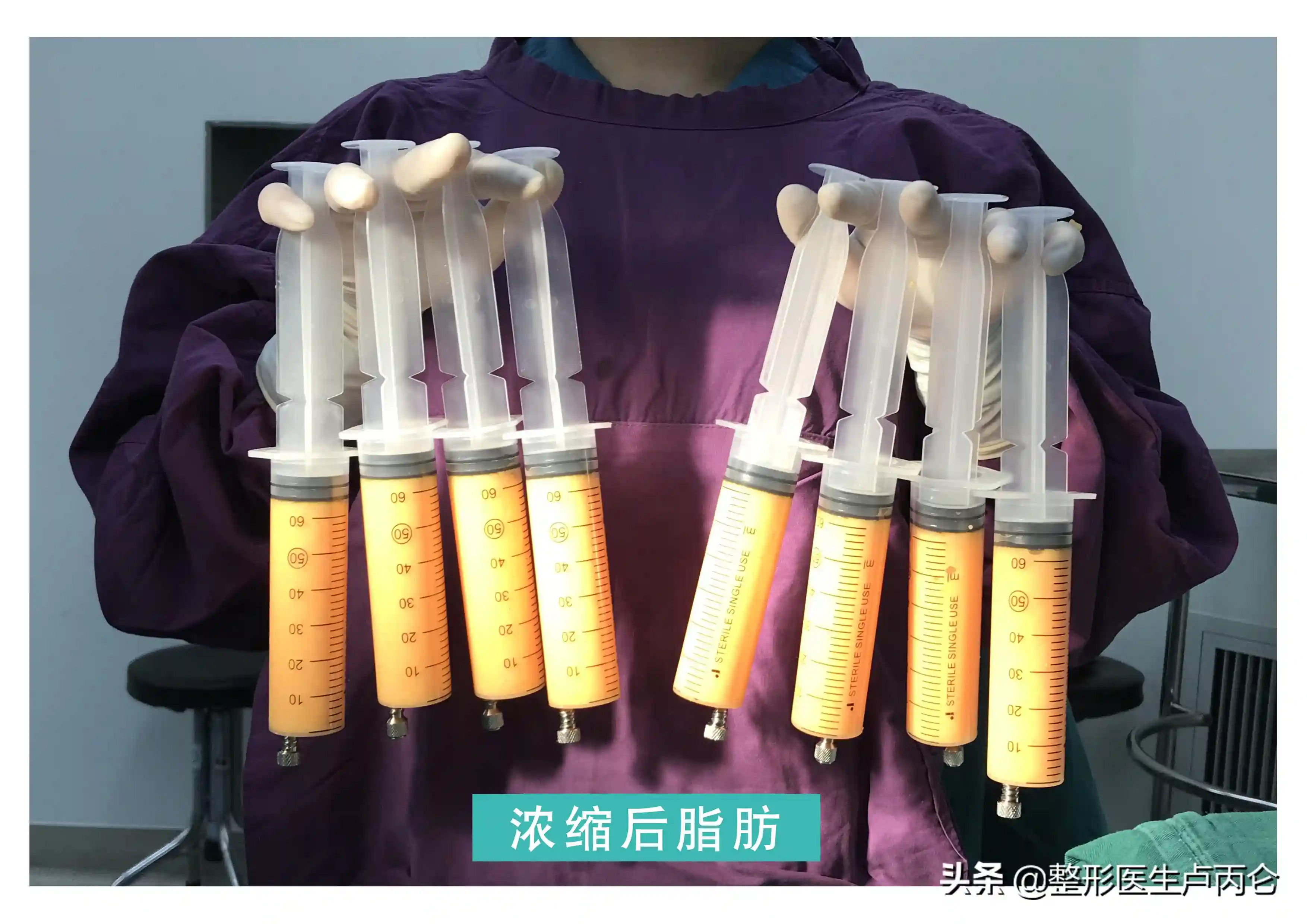 什么是自体脂肪移植？