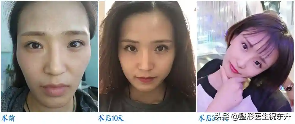 脂肪填充避开这些"坑"，术后"脸会很自然"...