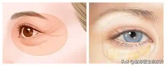 做完祛眼袋手术后，这些是可能出现的"异常"问题