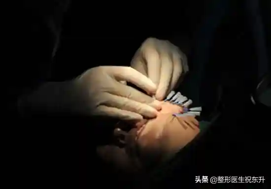 给"做面部线雕的人"一些真实建议，术前、术后的这些事需要注意