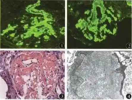 肾淀粉样病变，您知道吗？肾脏会有什么表现呢？
